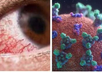 مرض الفطر الأسود وعلاقته بفايروس كورونا