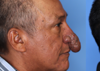 أمريكي يخضع لعملية تجميل الأنف الذي يعد من “أغرب” الأنوف في العالم (صور)