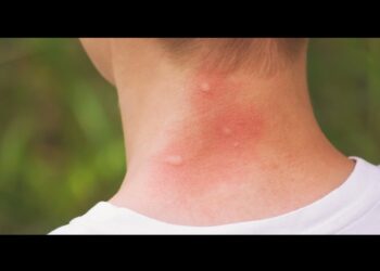 رائحة الإنسان تجذب البعوض