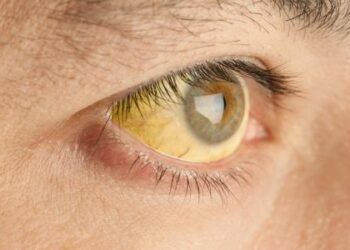 لبنان .. دعوة إلى إعلان حالة طوارئ صحية بسبب وباء “اليرقان”