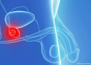 اكتشاف مؤشر يؤكد الإصابة بسرطان البروستاتا