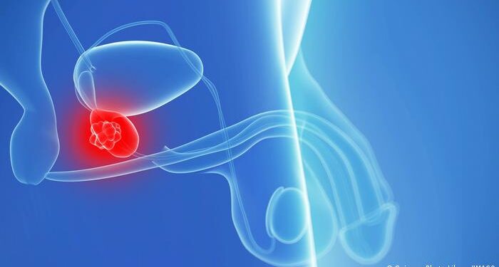 اكتشاف مؤشر يؤكد الإصابة بسرطان البروستاتا